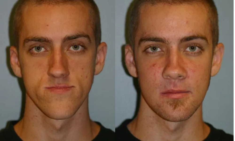 Clinical photo from Joe's corrective jaw surgery case
